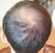 Keratin Hair Loss Concealer Kit | 3-Piece Set for Thinning Hair with 10 Color Options