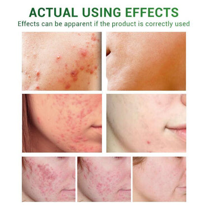 Advanced Acne Repair Serum with Camellia Sinensis & Plant Extracts